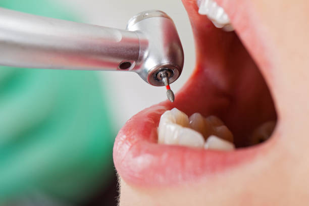 Best Emergency Root Canal Therapy in Walnut Creek, OH